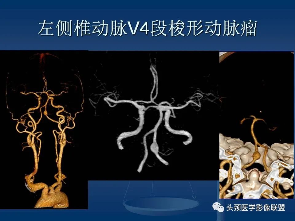 影像PPT - 【PPT】头颈部CTA和DSA对血管病变的诊断-44