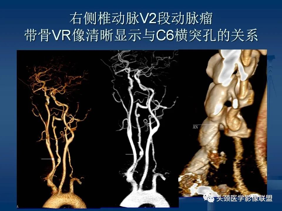 影像PPT - 【PPT】头颈部CTA和DSA对血管病变的诊断-45