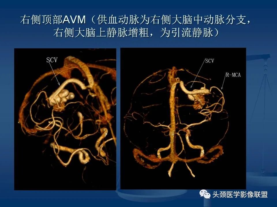 影像PPT - 【PPT】头颈部CTA和DSA对血管病变的诊断-49