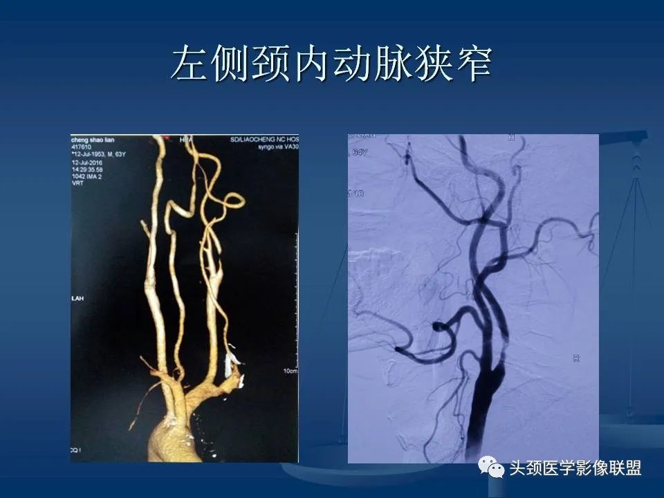 影像PPT - 【PPT】头颈部CTA和DSA对血管病变的诊断-52