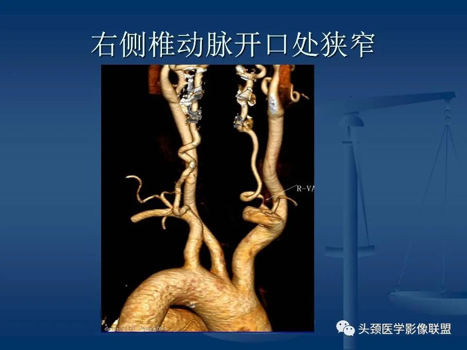 影像PPT - 【PPT】头颈部CTA和DSA对血管病变的诊断-53