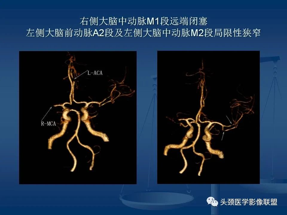 影像PPT - 【PPT】头颈部CTA和DSA对血管病变的诊断-55