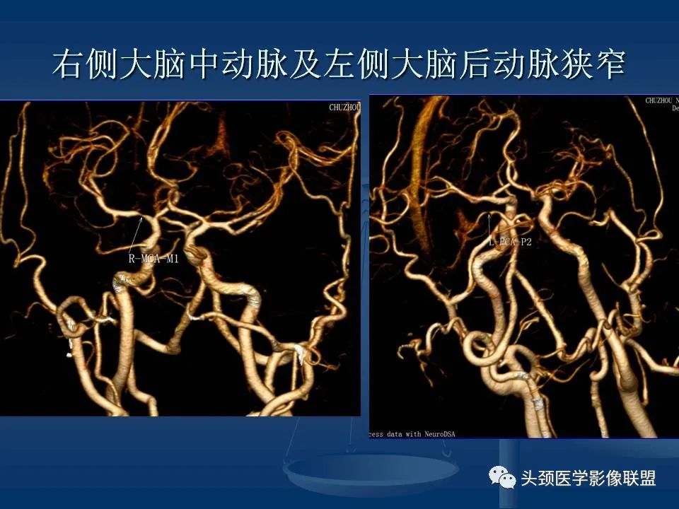 影像PPT - 【PPT】头颈部CTA和DSA对血管病变的诊断-54