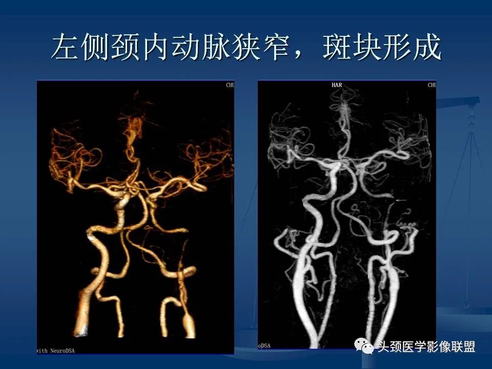 影像PPT - 【PPT】头颈部CTA和DSA对血管病变的诊断-56