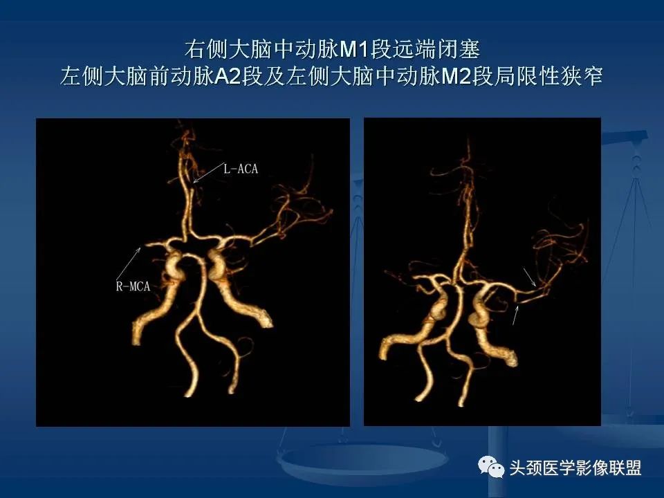 影像PPT - 【PPT】头颈部CTA和DSA对血管病变的诊断-57