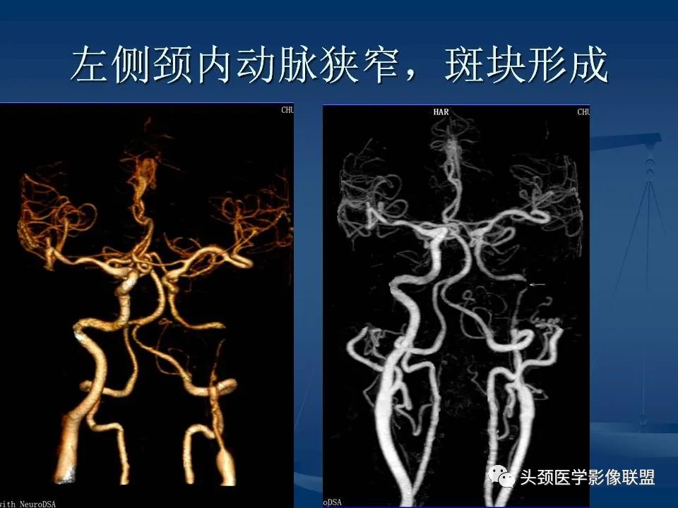 影像PPT - 【PPT】头颈部CTA和DSA对血管病变的诊断-58