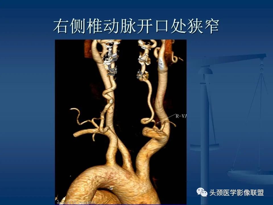 影像PPT - 【PPT】头颈部CTA和DSA对血管病变的诊断-59