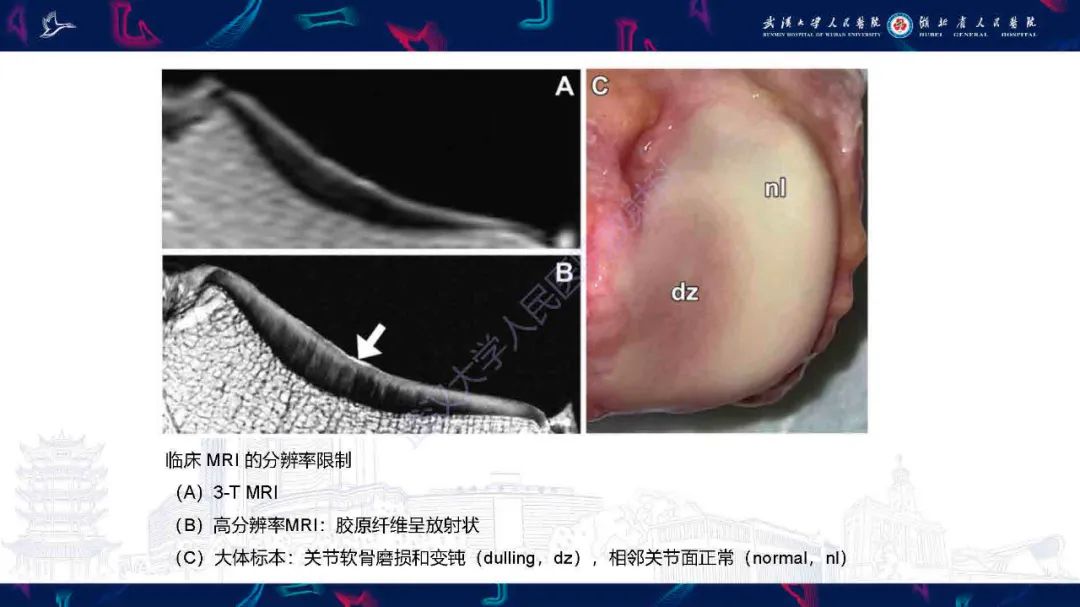 影像PPT - 【PPT】关节软骨损伤MRI诊断-9
