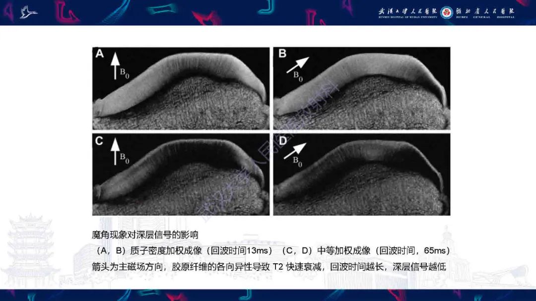 影像PPT - 【PPT】关节软骨损伤MRI诊断-10