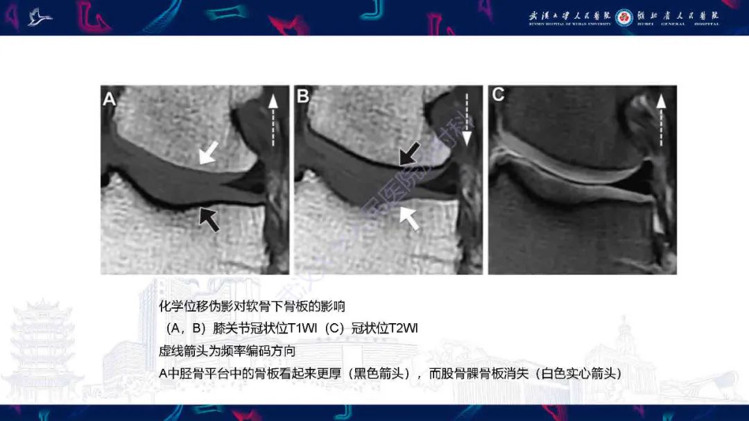 影像PPT - 【PPT】关节软骨损伤MRI诊断-13