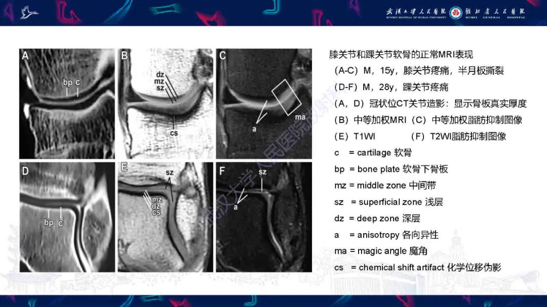 影像PPT - 【PPT】关节软骨损伤MRI诊断-14