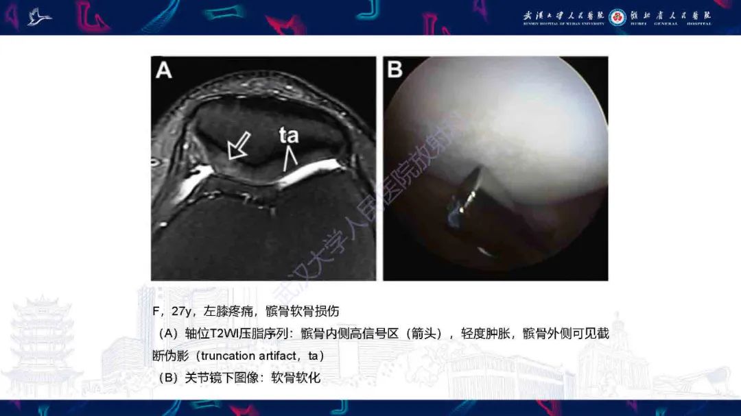 影像PPT - 【PPT】关节软骨损伤MRI诊断-21