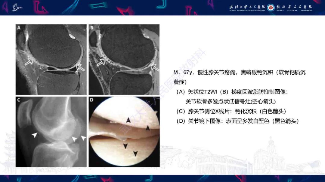 影像PPT - 【PPT】关节软骨损伤MRI诊断-23