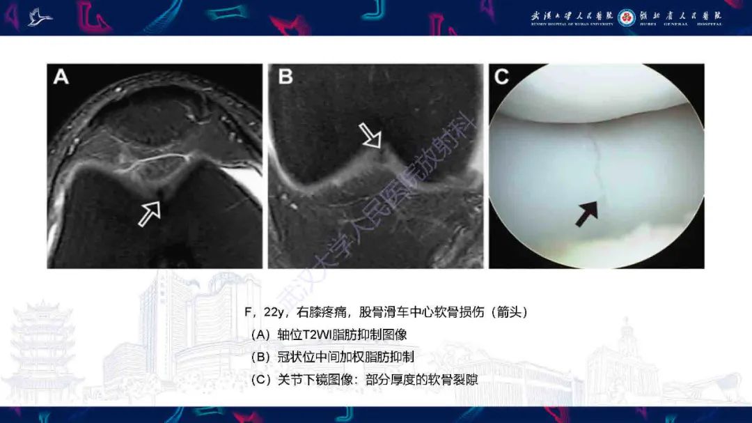 影像PPT - 【PPT】关节软骨损伤MRI诊断-22