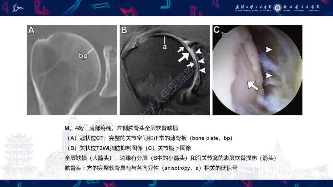 影像PPT - 【PPT】关节软骨损伤MRI诊断-28