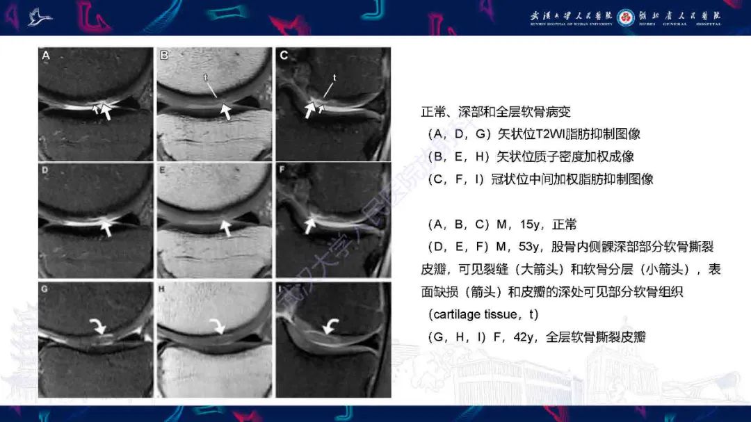 影像PPT - 【PPT】关节软骨损伤MRI诊断-27