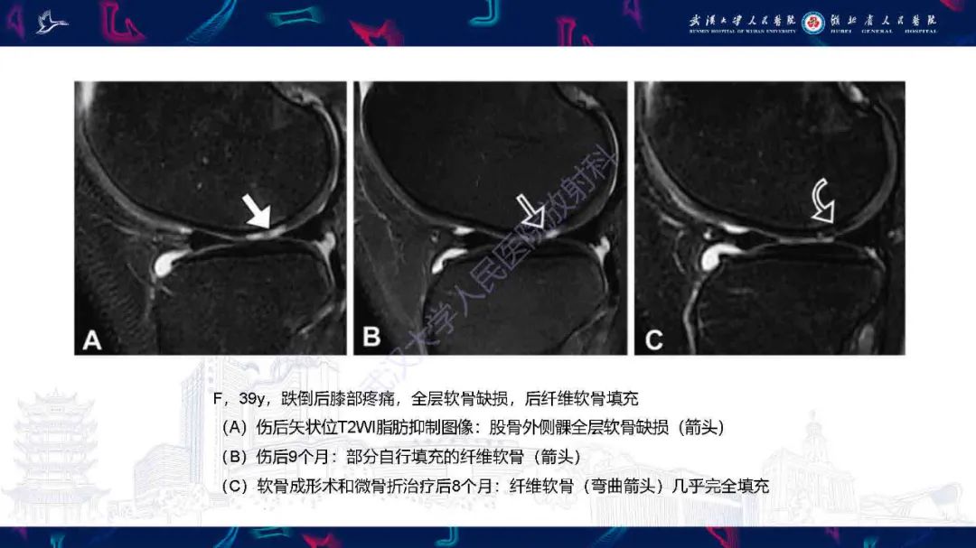 影像PPT - 【PPT】关节软骨损伤MRI诊断-30