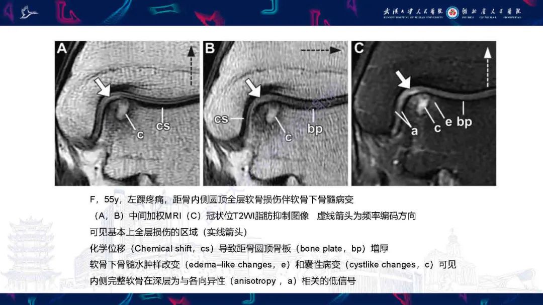 影像PPT - 【PPT】关节软骨损伤MRI诊断-33