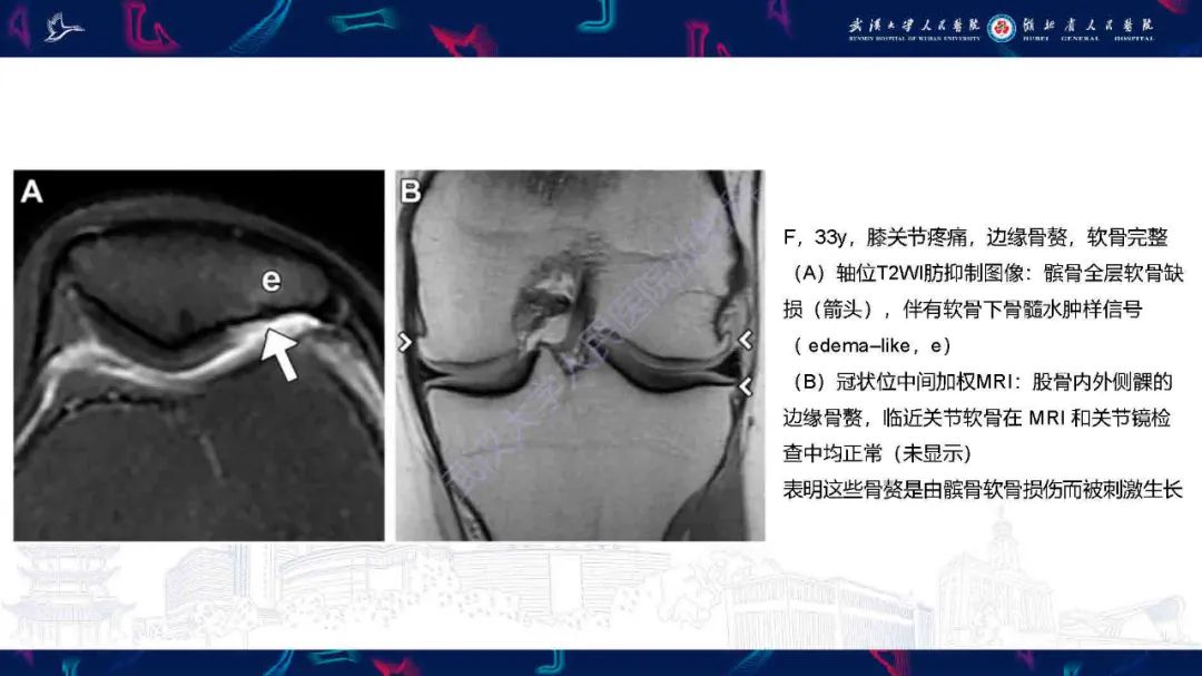 影像PPT - 【PPT】关节软骨损伤MRI诊断-36