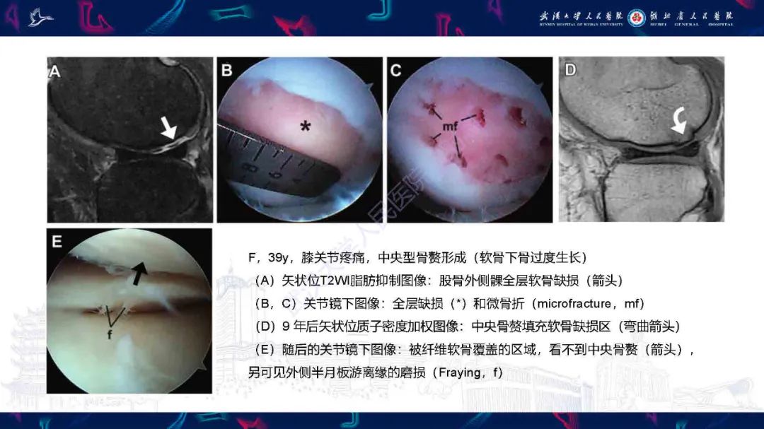 影像PPT - 【PPT】关节软骨损伤MRI诊断-38