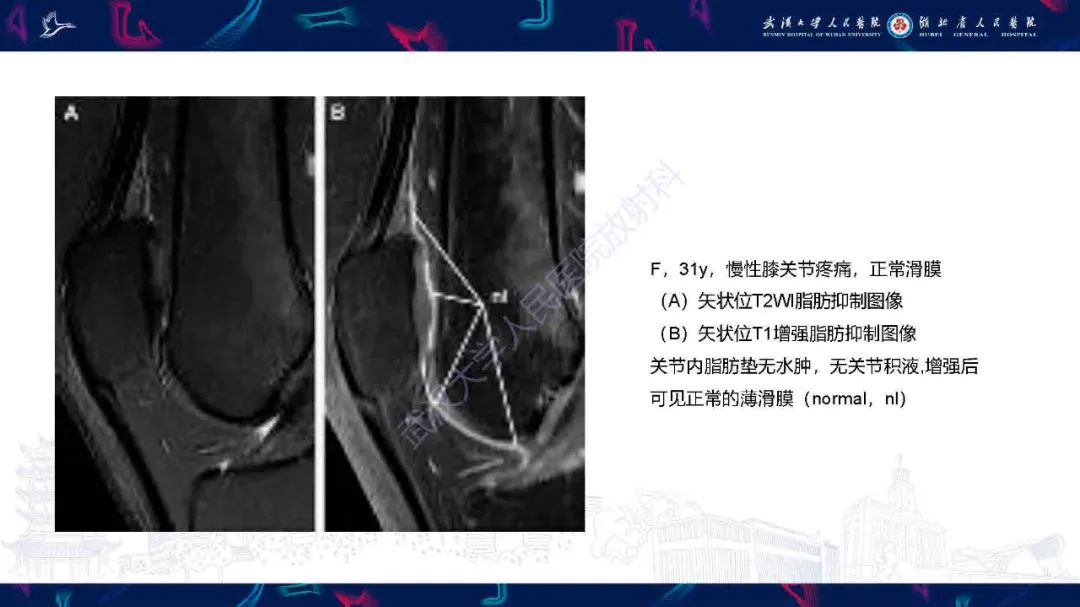 影像PPT - 【PPT】关节软骨损伤MRI诊断-41