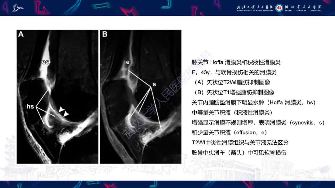 影像PPT - 【PPT】关节软骨损伤MRI诊断-42