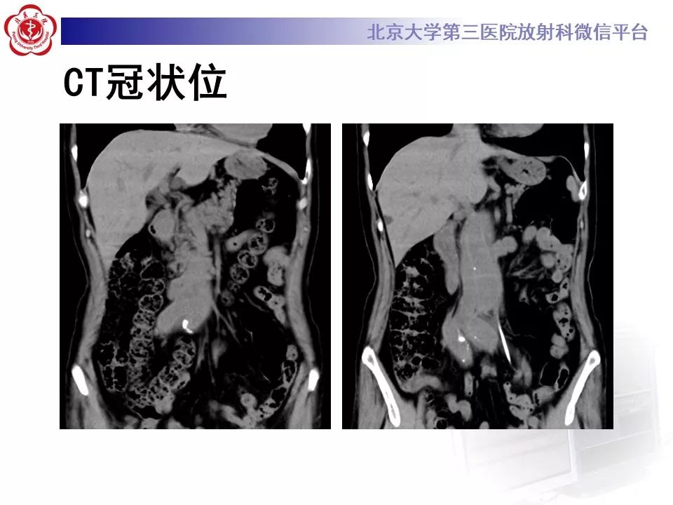 影像PPT - 【PPT】腹膜后纤维化-4