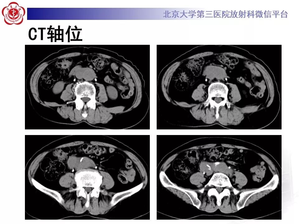 影像PPT - 【PPT】腹膜后纤维化-3
