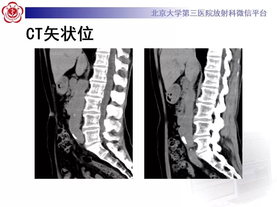 影像PPT - 【PPT】腹膜后纤维化-5