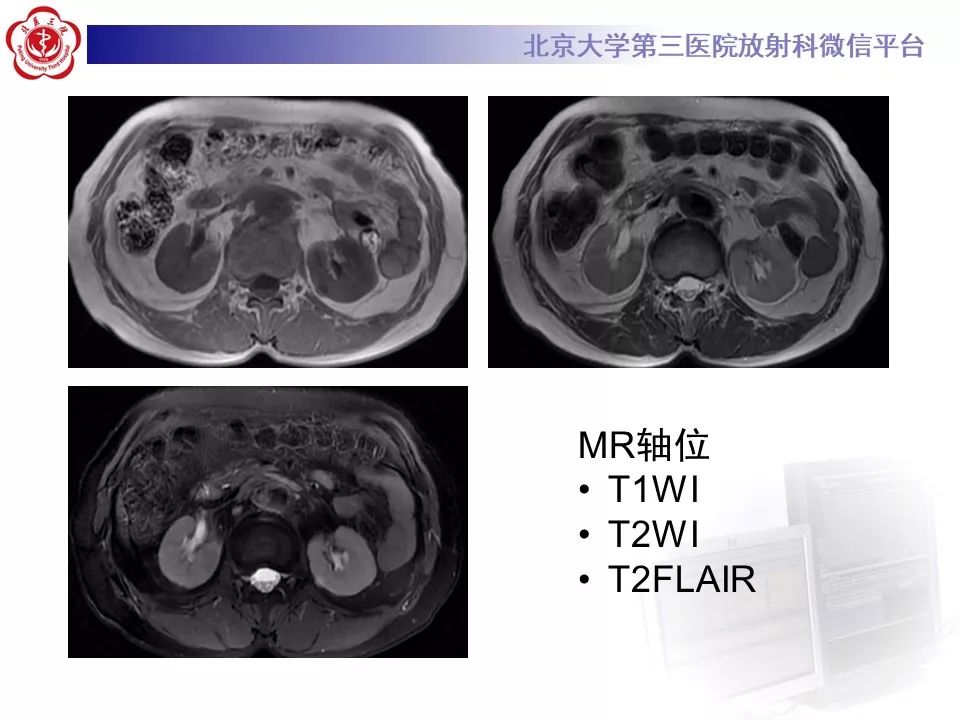 影像PPT - 【PPT】腹膜后纤维化-6