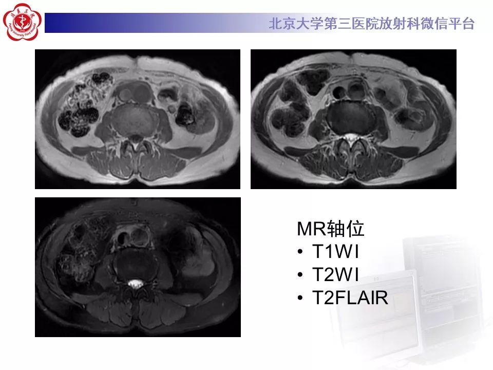 影像PPT - 【PPT】腹膜后纤维化-7