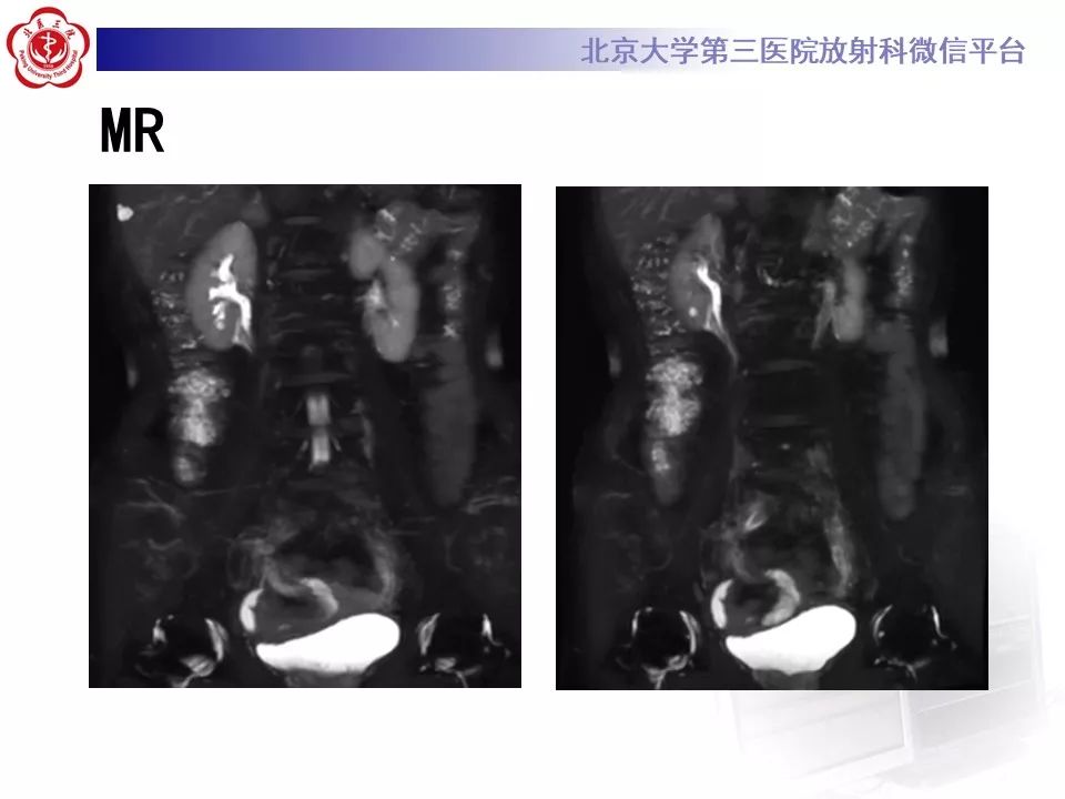 影像PPT - 【PPT】腹膜后纤维化-8