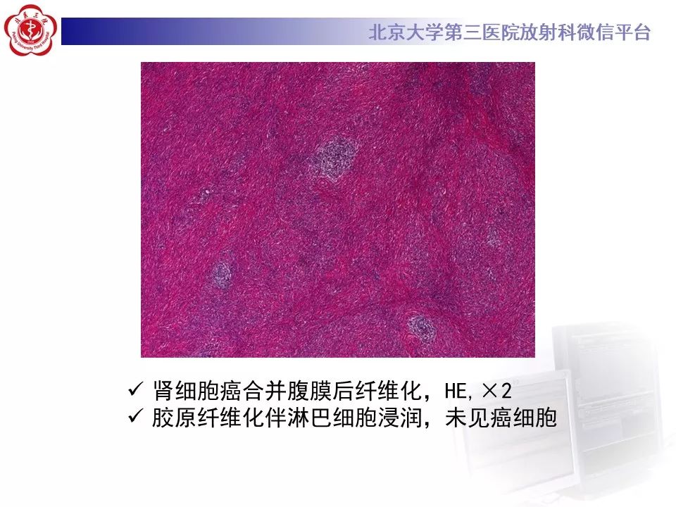 影像PPT - 【PPT】腹膜后纤维化-19