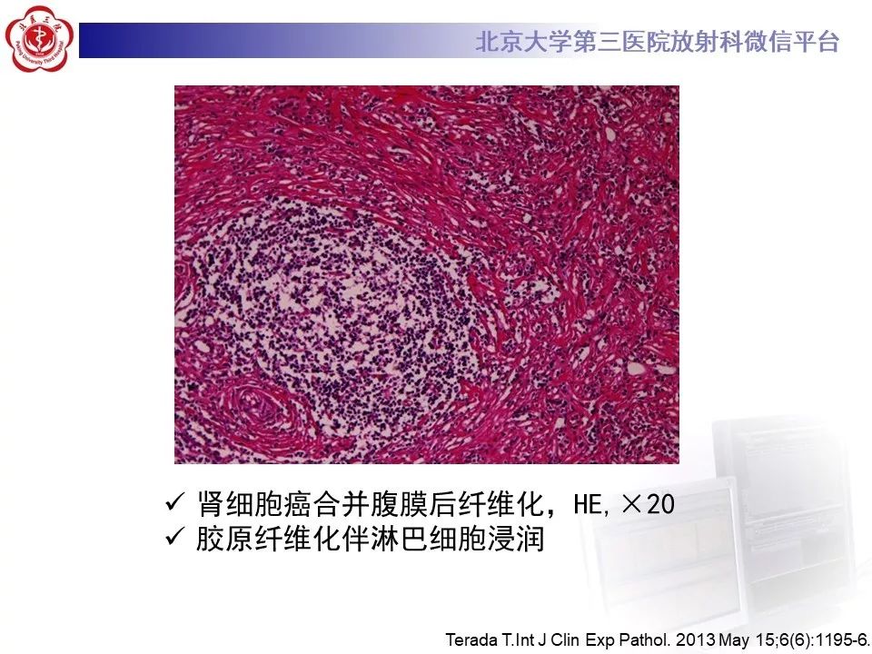 影像PPT - 【PPT】腹膜后纤维化-20