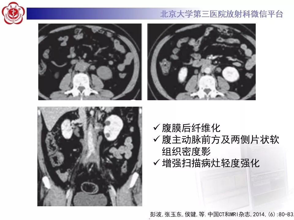 影像PPT - 【PPT】腹膜后纤维化-24