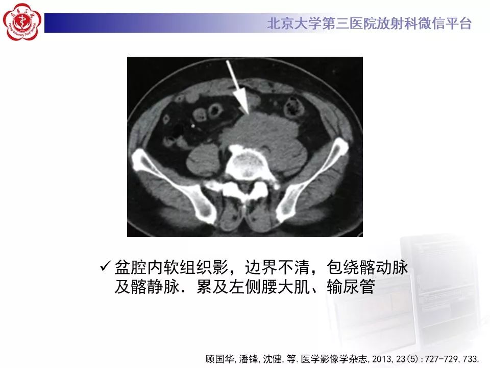 影像PPT - 【PPT】腹膜后纤维化-25