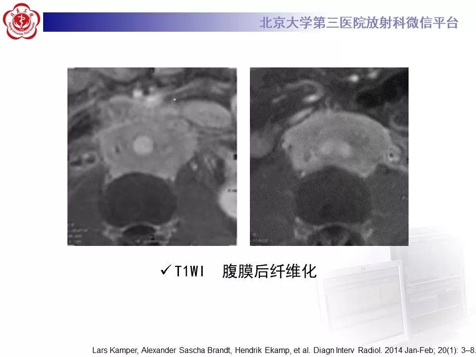 影像PPT - 【PPT】腹膜后纤维化-27