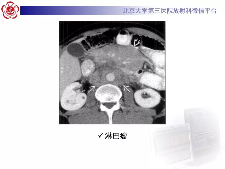 影像PPT - 【PPT】腹膜后纤维化-30