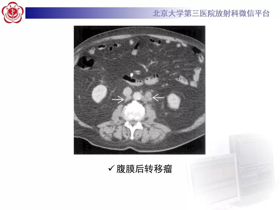 影像PPT - 【PPT】腹膜后纤维化-31