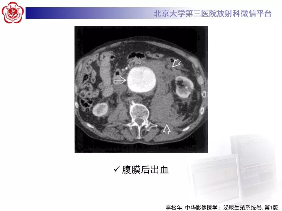 影像PPT - 【PPT】腹膜后纤维化-32