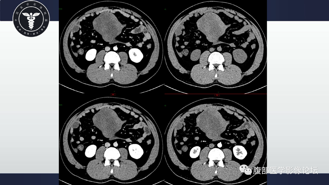 影像PPT - 【病例】肠系膜侵袭性纤维瘤病1例CT-5