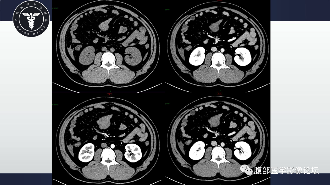 影像PPT - 【病例】肠系膜侵袭性纤维瘤病1例CT-3