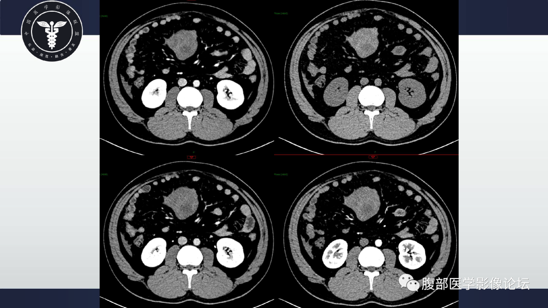 影像PPT - 【病例】肠系膜侵袭性纤维瘤病1例CT-4