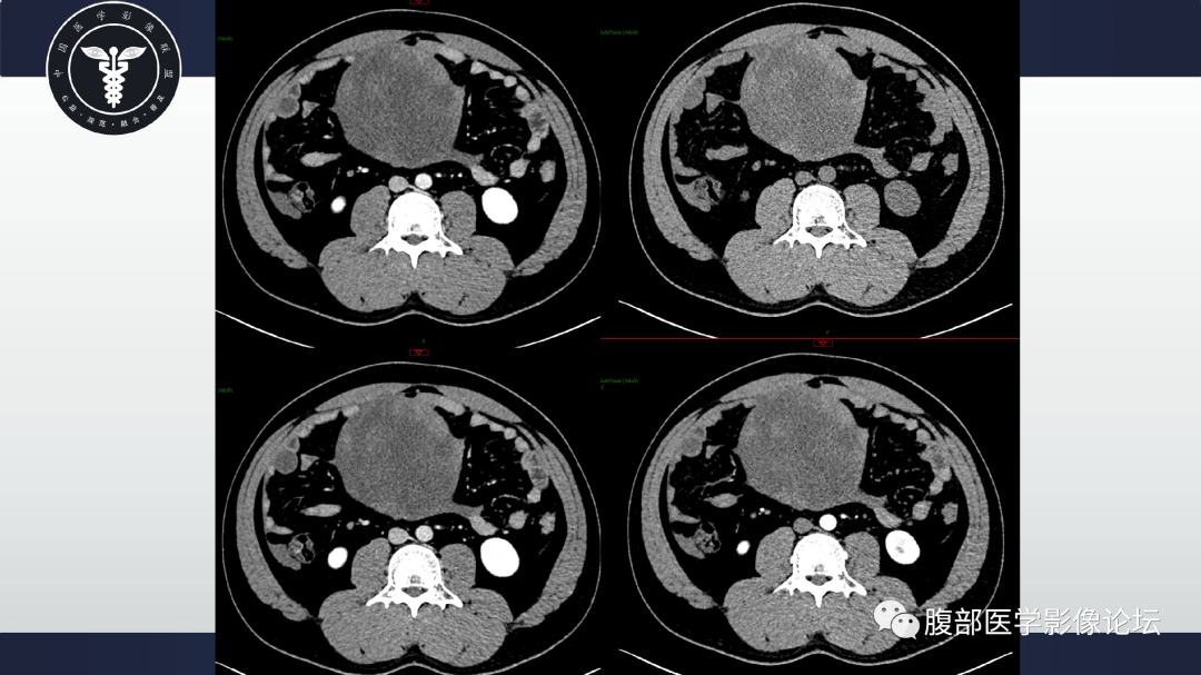 影像PPT - 【病例】肠系膜侵袭性纤维瘤病1例CT-6