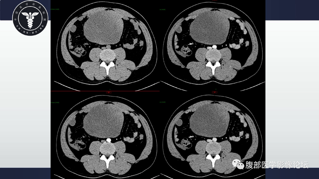 影像PPT - 【病例】肠系膜侵袭性纤维瘤病1例CT-7