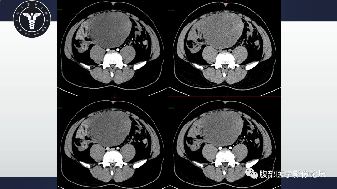 影像PPT - 【病例】肠系膜侵袭性纤维瘤病1例CT-8