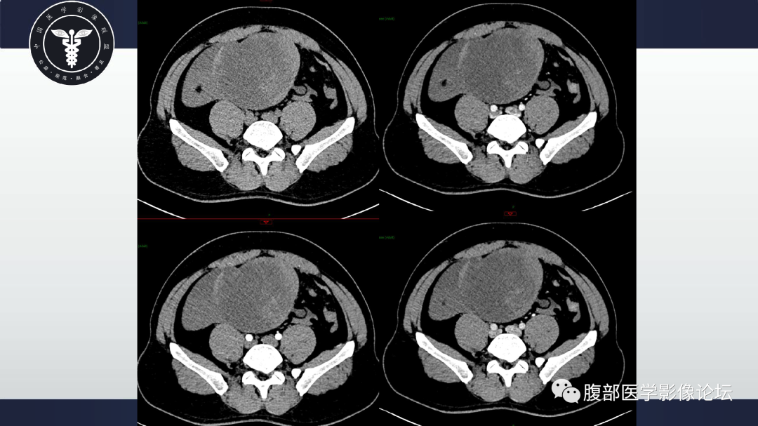 影像PPT - 【病例】肠系膜侵袭性纤维瘤病1例CT-9