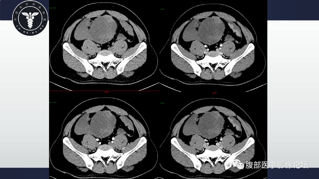 影像PPT - 【病例】肠系膜侵袭性纤维瘤病1例CT-10