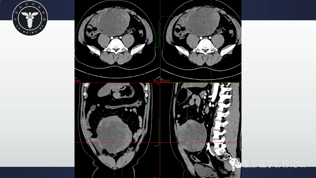 影像PPT - 【病例】肠系膜侵袭性纤维瘤病1例CT-11