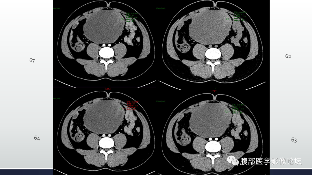 影像PPT - 【病例】肠系膜侵袭性纤维瘤病1例CT-12